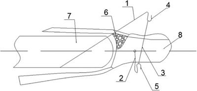 New technique for the treatment of fresh bony mallet finger: A retrospective case series study